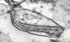 M,71y. | promelanosome - skin melanoblastoma